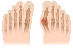 hallux-valgus