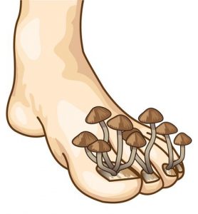 mycose ongle pied