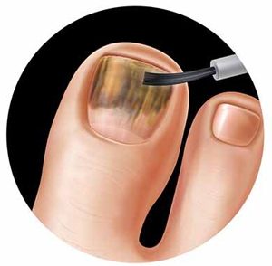 vernis antifongiques