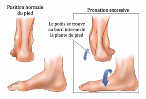 pronation excessive