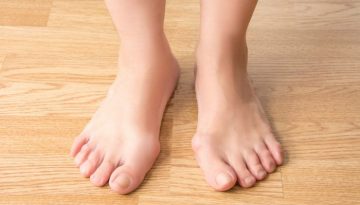 hallus-valgus